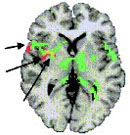 fMRI image of pain in FM brain.